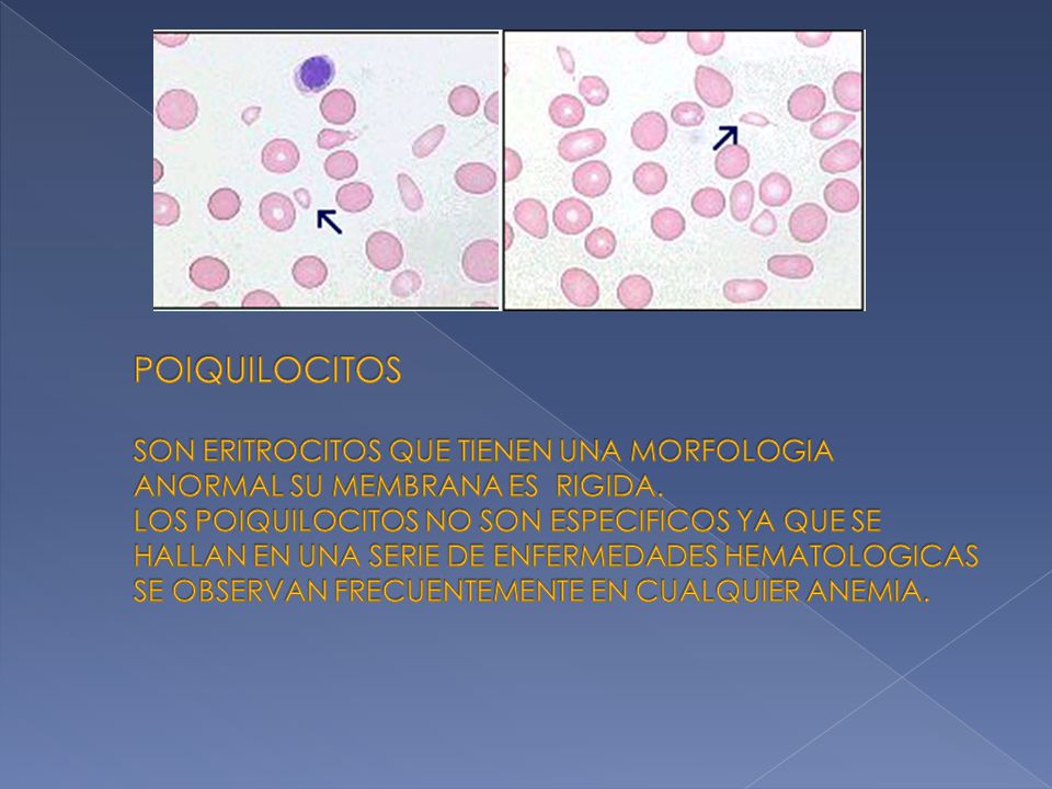hematies en forma de lagrima